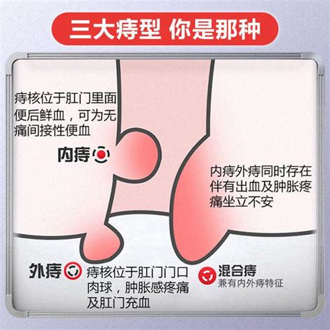 內外痣|痔瘡症狀會自己好嗎？內痣、外痣症狀差異、治療看什。